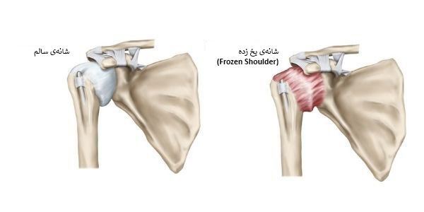 شانه یخ زده یا فروزن شولدر و درمان آن