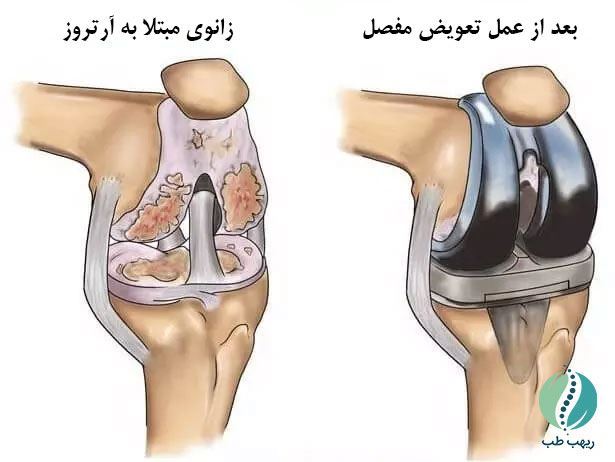 فیزیوتراپی تعویض مفصل زانو در منزل